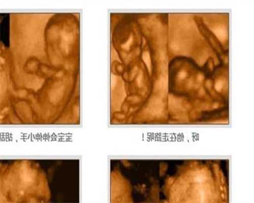 深圳代孕手术需多少钱_孕妇长期睡眠不足对胎儿的影响有哪些